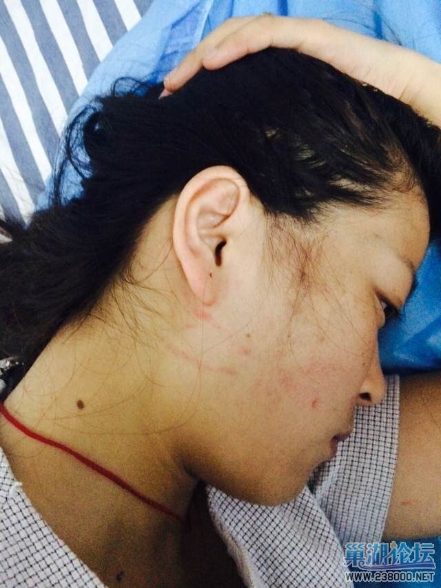 被拽掉耳钉和抠破的脸